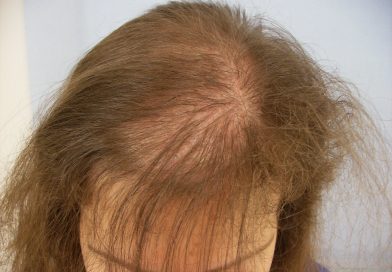 alopecia-femminile1