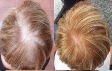 Foltina Plus Recensioni Vere: Ecco come sono riuscita a fermare la caduta dei capelli